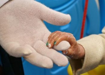 خطر جدی در کمین جان بیماران پروانه‌ای ایران: پنج تن پانسمان بیماران پروانه‌ای در ایران ناپدید شده است